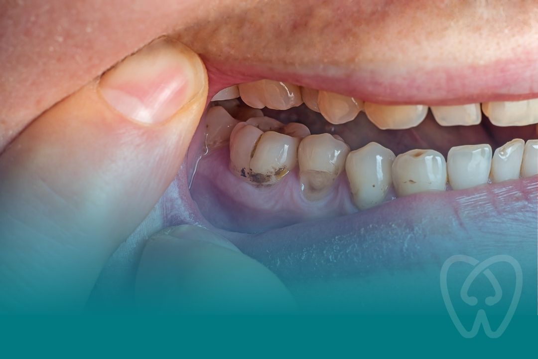 Therapeutic Dentistry